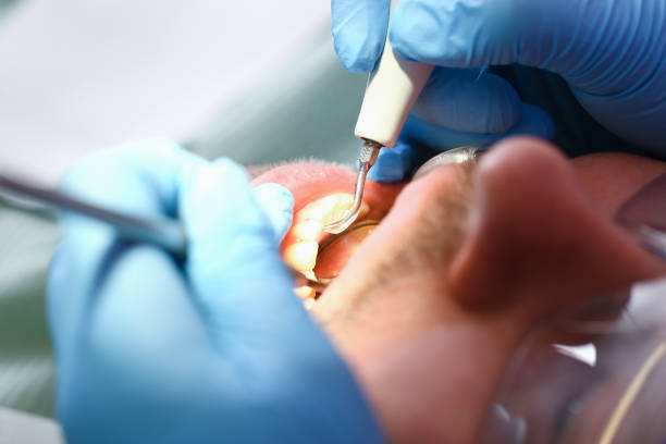 Best Emergency Root Canal Treatment in Glade Spring, VA