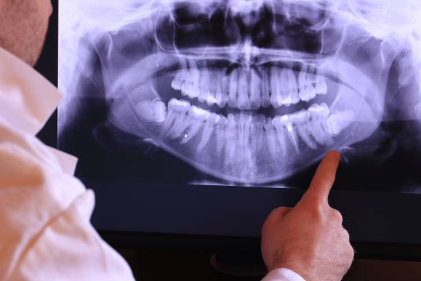 Best Emergency Wisdom Teeth Removal in Glade Spring, VA